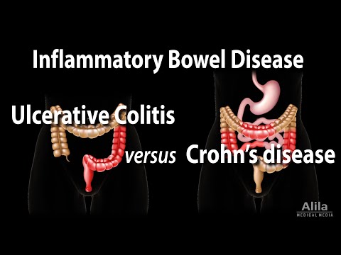 Ulcerative Colitis versus Crohn&rsquo;s Disease, Animation