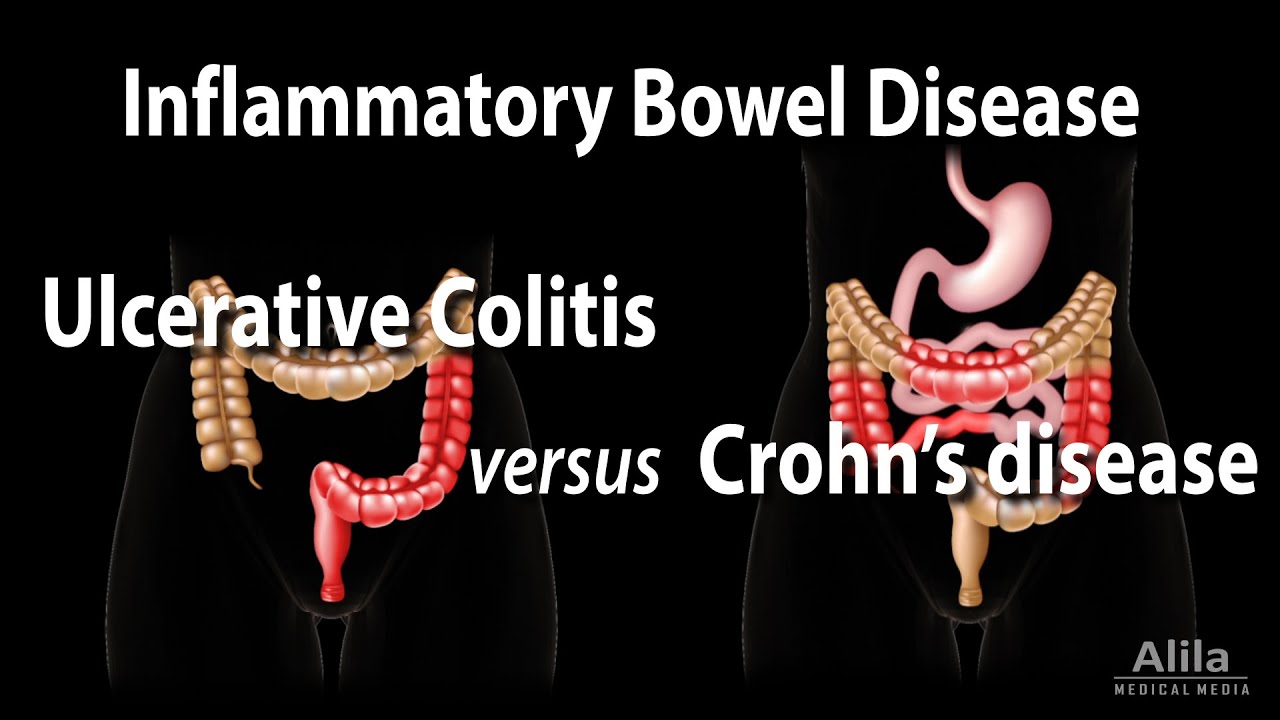 helmintikus terápia a crohn-betegségben