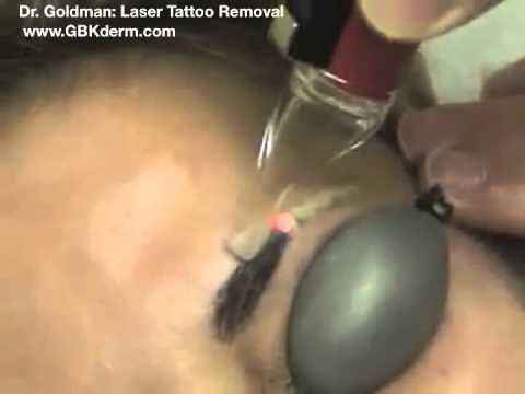 laser tattoo removal removing eyebrow tattoo san diego youtube laser tattoo removal removing eyebrow tattoo san diego youtube