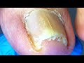 Toenails Have Two Sharp Corners ~ Remove Dead Skin