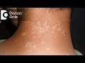 Pharmacological management of Tinea Versicolor in young individuals - Dr. Urmila Nischal