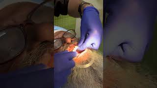 Implant Complete! Temporary Bridge lag gaya, ab Titanium PFM ki bari 🔥"#viral #shortvideo