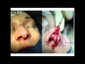 Rhinoplasty - The Alar Rim Graft