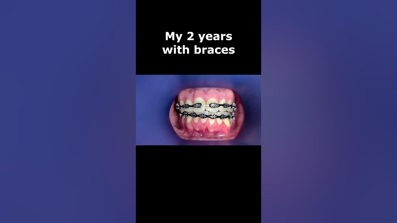 My 2 Years Of Braces So Far Braces Timelapse shorts YouTube