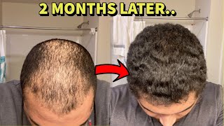 BALD GUY REVERSES HAIR LOSS IN 2 MONTHS! HERE'S WHAT HE DID! screenshot 2