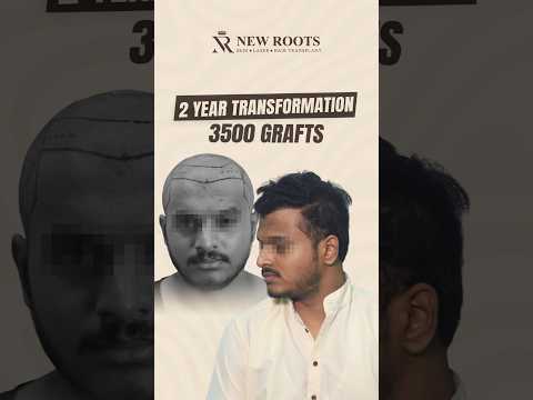 3500 Grafts Hair Transformation | Hair Transplant in Vashi, Navi Mumbai #shorts
