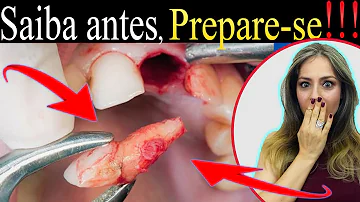 Como se preparar para arrancar um dente?