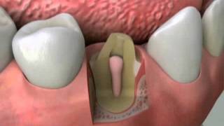 Root Canal Cast Post & Core - Roseville Dentist