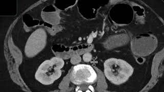 Gallstone ileus
