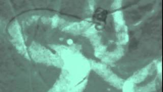 Coiling_RupAn_02-01-12.mp4 02 Coiling Aneurysms
