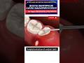 How To Remove Mesio Angular Wisdom Tooth Painlessly Wisdomtooth Teethpain Dentist How To Remove Mesio Angular Wisdom Tooth Painlessly Wisdomtooth Teethpain Dentist