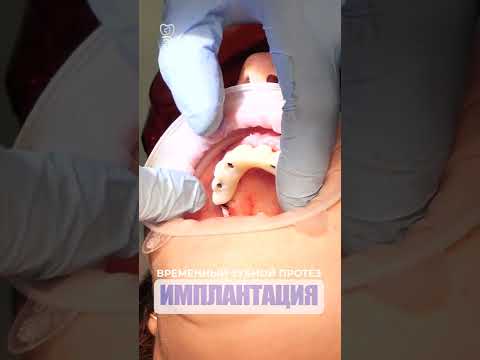 Временный зубной протез.Temporary denture. Implantation.