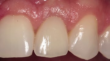 Cervico System/Concept Course - Dental Exelixis