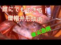 僧帽弁形成術はもう怖くない!考え方と基本手技 Mitral Valve Plasty for Posterior Leaflet Prolapse 【俺に切らせろ!】