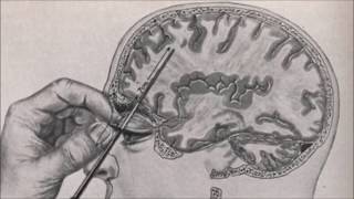 Brain dead pubber