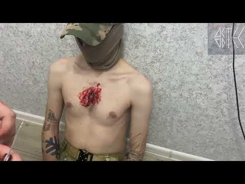 Окклюзионный пластырь ГЕПОГЛОС. Я такого не ожидал.