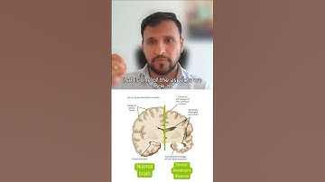 Brain atrophy & dementia  #brainhealth  #dementia #ageing #neuroscience #science