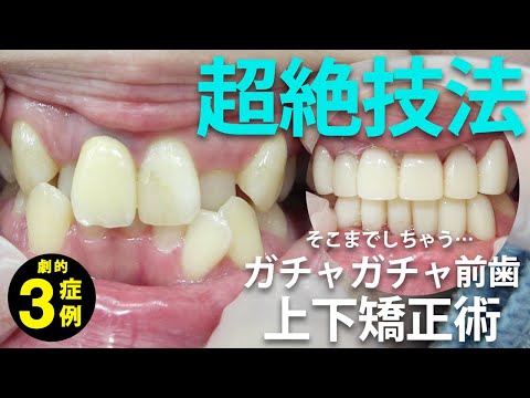 【セラミック矯正】ガチャガチャ前歯→嚙み合わせまで超絶変身！！