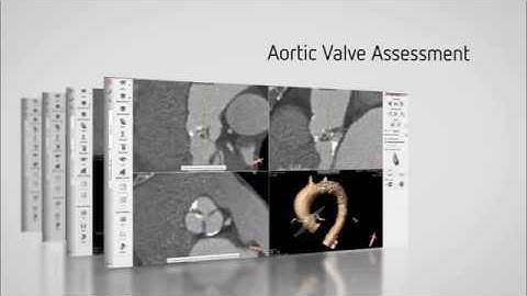 3mensio Aortic Valve