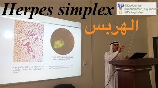 فيروس الهربس البسيط | Herpes simplex virus