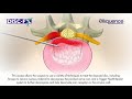 Малоинвазивное оперативное лечение и ведение пациентов с межпозвонковой грыжей