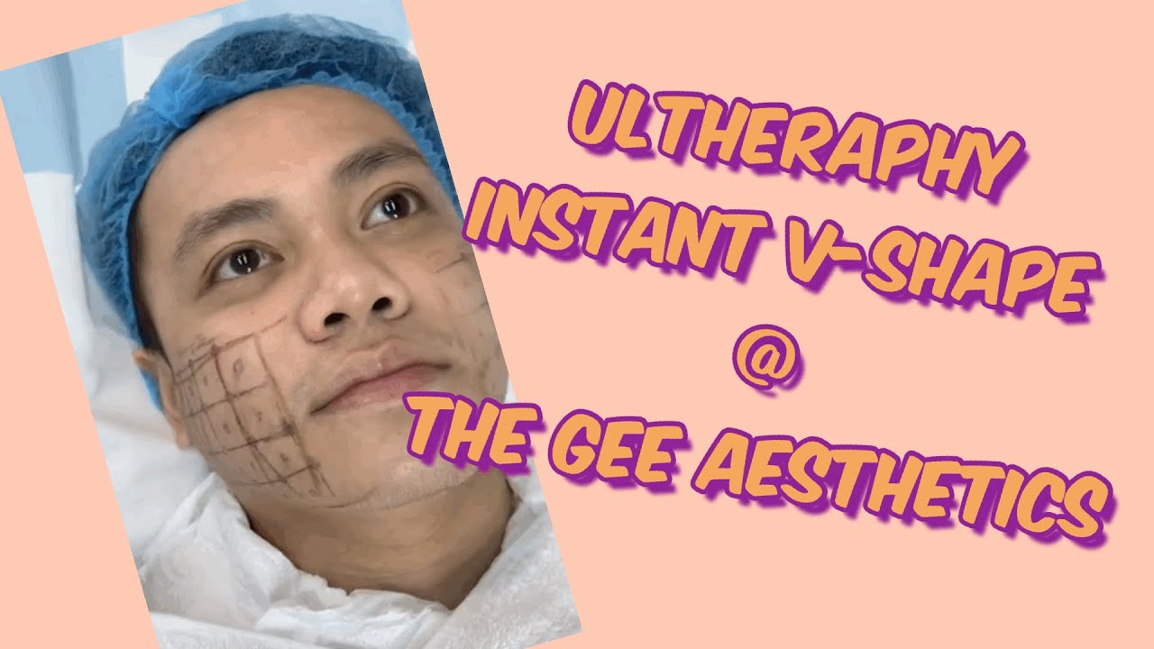 Ultherapy Honest Review @ The Gee Aesthetics