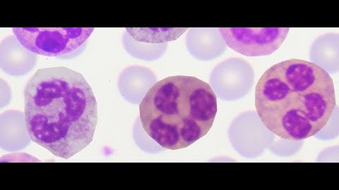 1 Slide in 5 Minutes: Phacoantigenic Glaucoma (Malik Y. Kahook, MD)