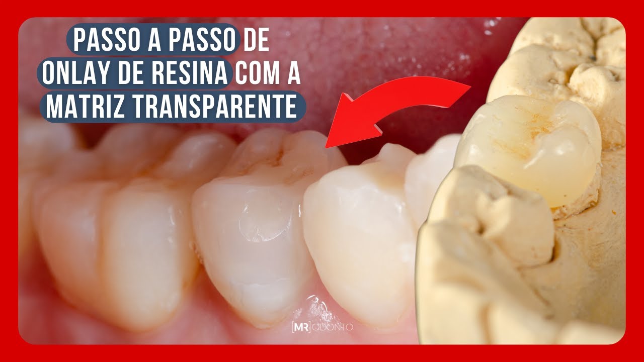PASSO A PASSO DE ONLAY DE RESINA COM A MATRIZ TRANSPARENTE