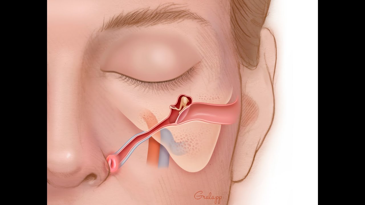 Come risolvere la disfunzione tubarica con la Balloon Tuboplasty