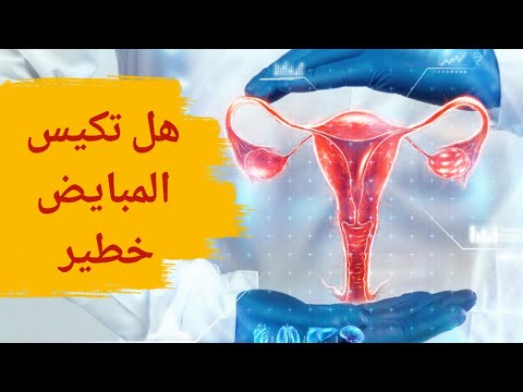 هل تكيس المبايض خطير متى يكون كيس المبيض خطير