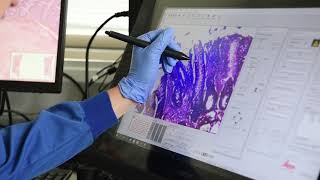 Sanger Institute - Crypt by Crypt: Using Laser Capture Microscopy to study colon cancer and IBD