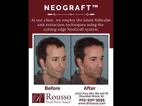 Neograft is a cutting edge system that is performed at Rousso Facial Plastic Surgery!