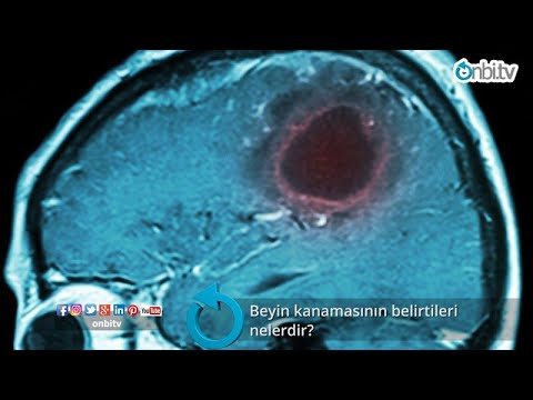 Video: Beyin qansızmaları ağrılıdır?