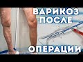 ПОЧЕМУ ВАРИКОЗ МОЖЕТ ВЕРНУТЬСЯ ПОСЛЕ ЛАЗЕРНОГО УДАЛЕНИЯ ВЕН? КОНСУЛЬТАЦИЯ