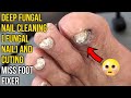 Deep Fungal Nail Cleaning [ FUNGAL NAIL] and cutting By Miss Foot Fixer Marion Yau
