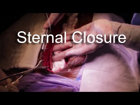Video: Proces štítné žlázy Jako Prediktivní Faktor Sternotomie V Léčbě Cerviko-mediastinálního Strumu