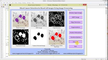 Matlab Project Blood Cancer (Leukemia Cancer) Detection Using Image Processing || IEEE Based Project