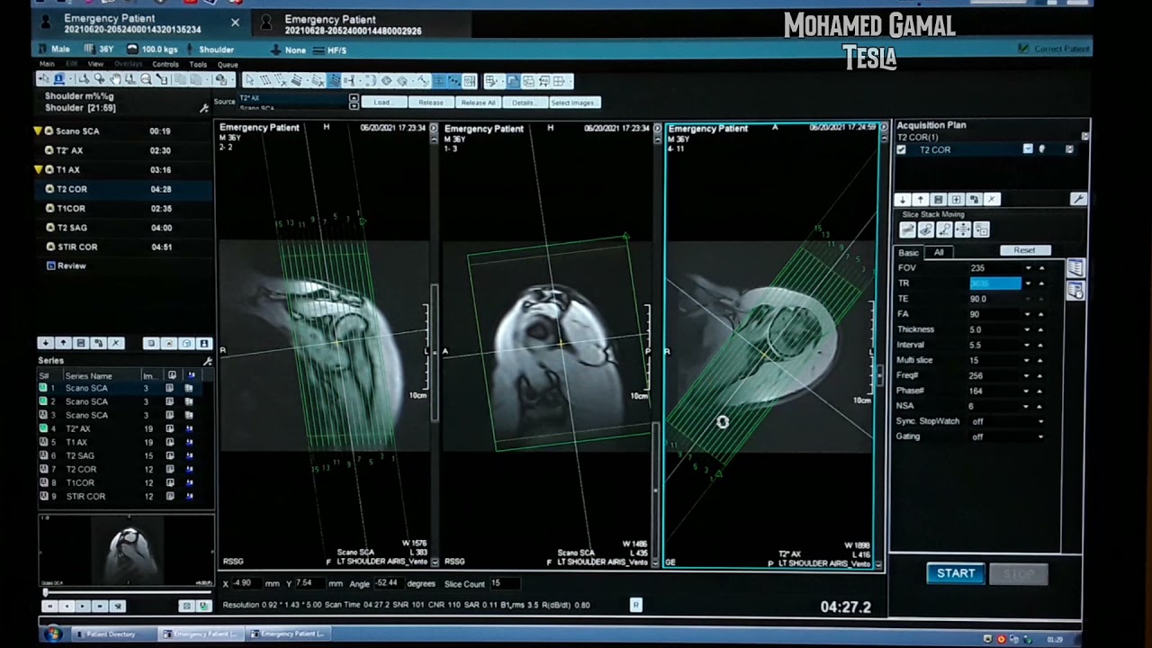 MRI SHOULDER خطوات تخطيط فحص الكتف بالرنين المغناطيسي