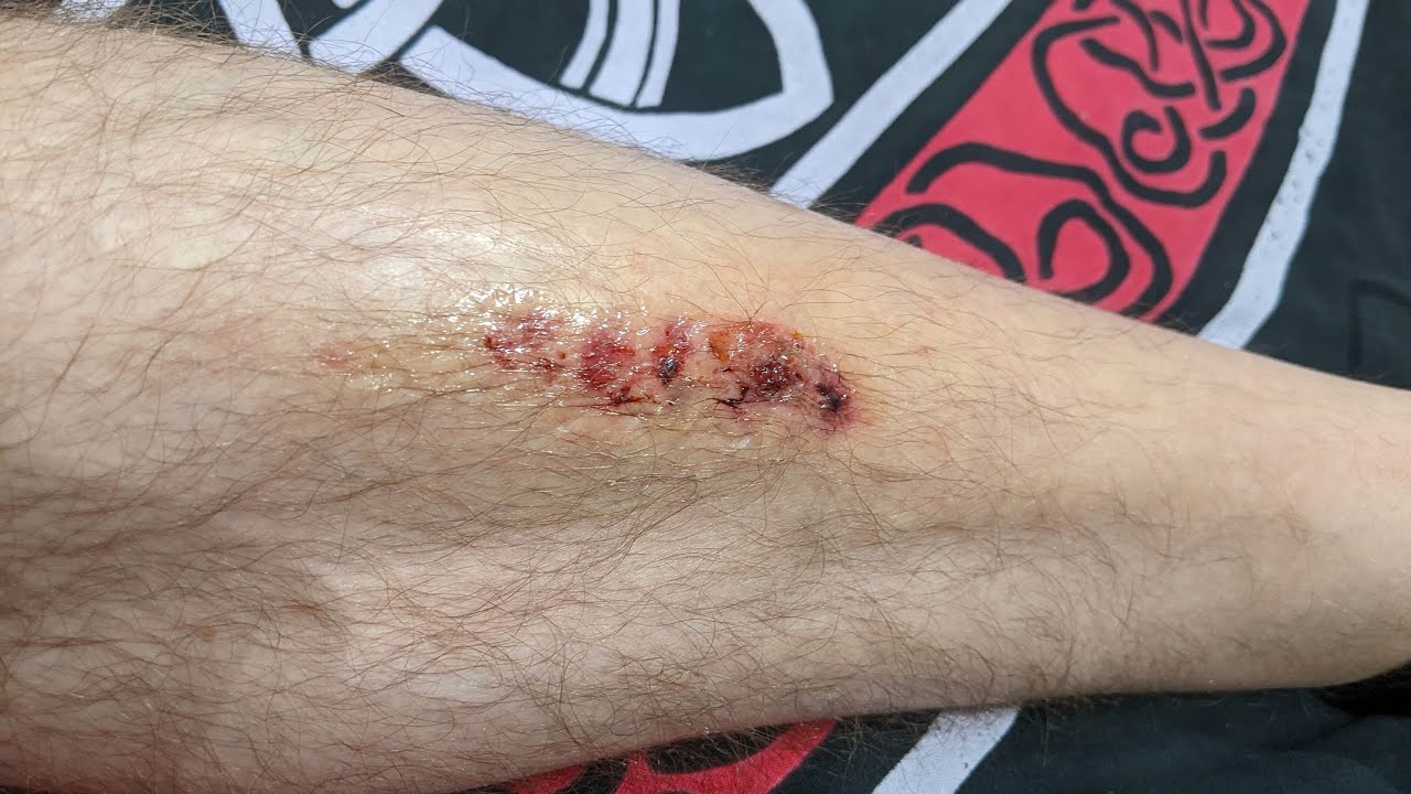 New Skin scab removal. NOT FOR THE SQUEAMISH! YouTube