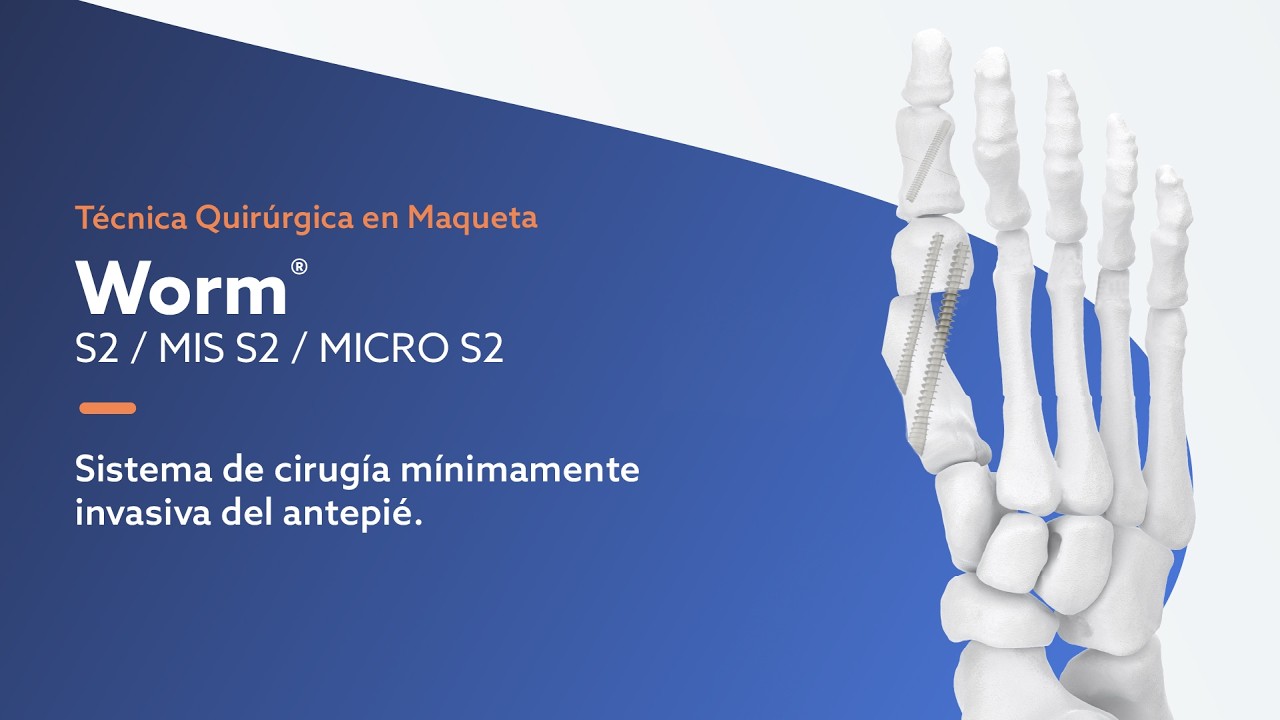 Worm® S2 / MIS S2 / MICRO S2. Sistema para cirugía mínimamente invasiva del antepié