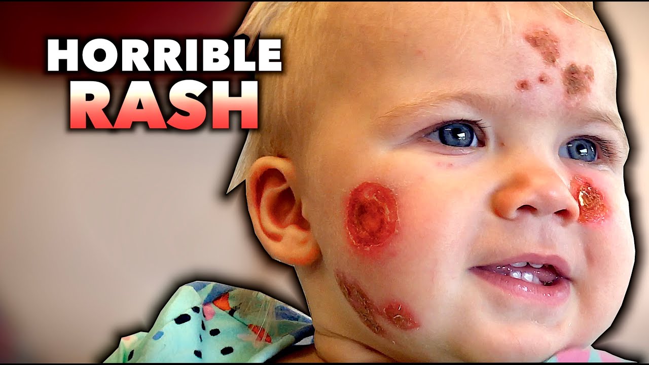 Scariest Rash HORRIBLE RASH... What Could It Be? (+ Special Announcement) | Dr. Paul ...