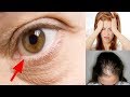 5 Signs And Symptoms Of IRON Deficiency YOU NEED To Know(Aud. Tewfiq Siliman Herini… Erbil-Kurdistan tewfiqsiliman@yahoo.com... 009647504485973)