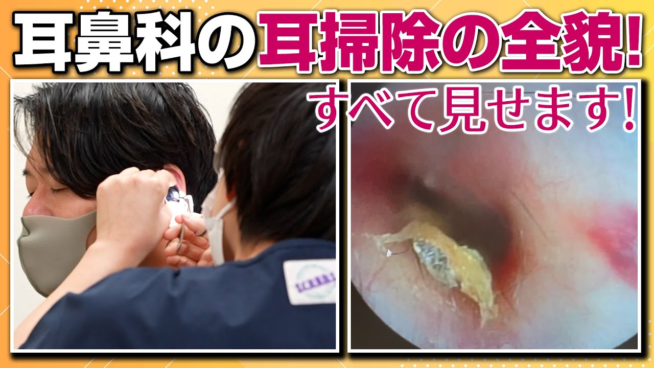 耳鼻 科 耳 掃除