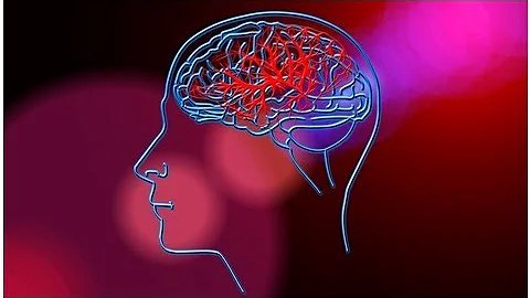 Quanto si vive con un glioblastoma multiforme?