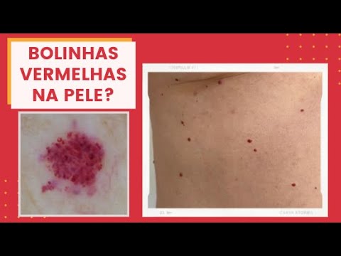 Vídeo: Quando o angioma de aranha desaparece?