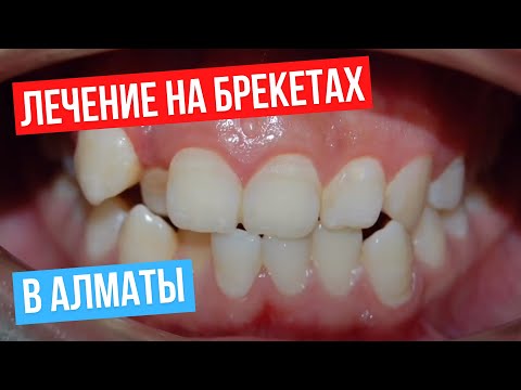 Лечение на брекетах в Алматы. До и После.
