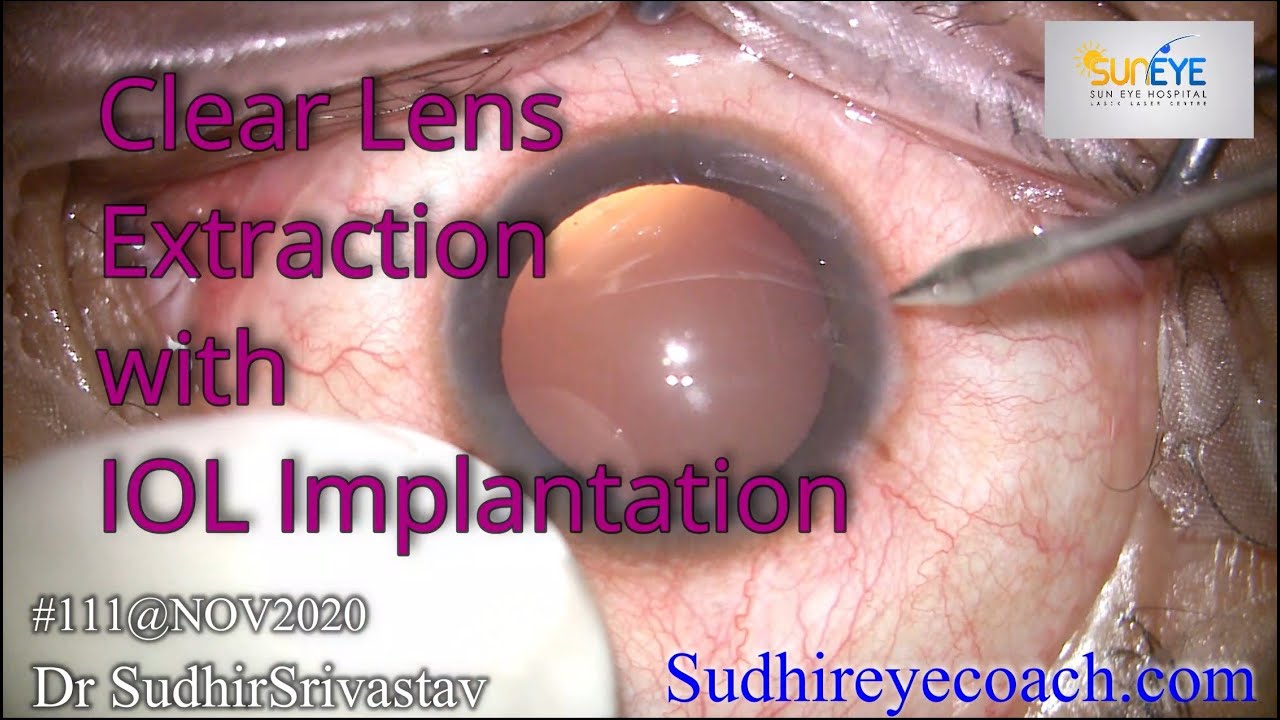 Clear Lens Extraction with IOL Implantation in Myopic Eye (Cataract