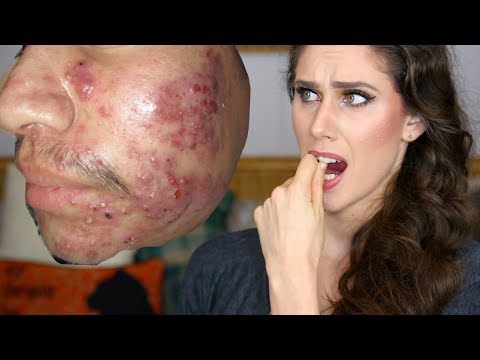 This isn&rsquo;t acne... but WHAT IS IT AND HOW DO YOU GET RID OF IT?!