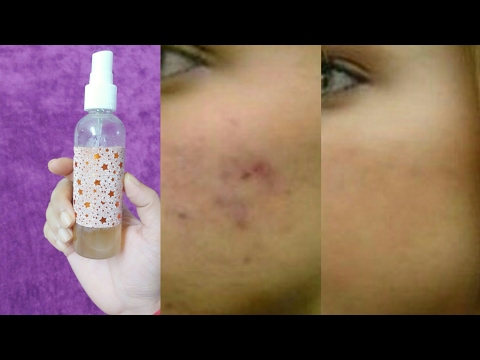 Use this natural Toner and get rid of acne in a Week, DIY toner for Acne,