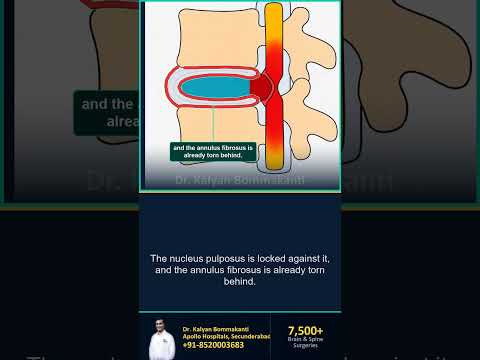 Why a Dropping Foot Can't Wait — Best Endoscopic Spine Surgeon, Hyderabad